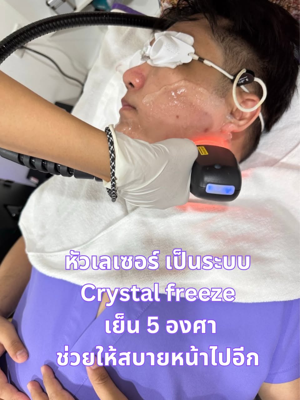เลเซอร์ขน 3 พลังงาน Apex Profound Beauty รูปที่ 3